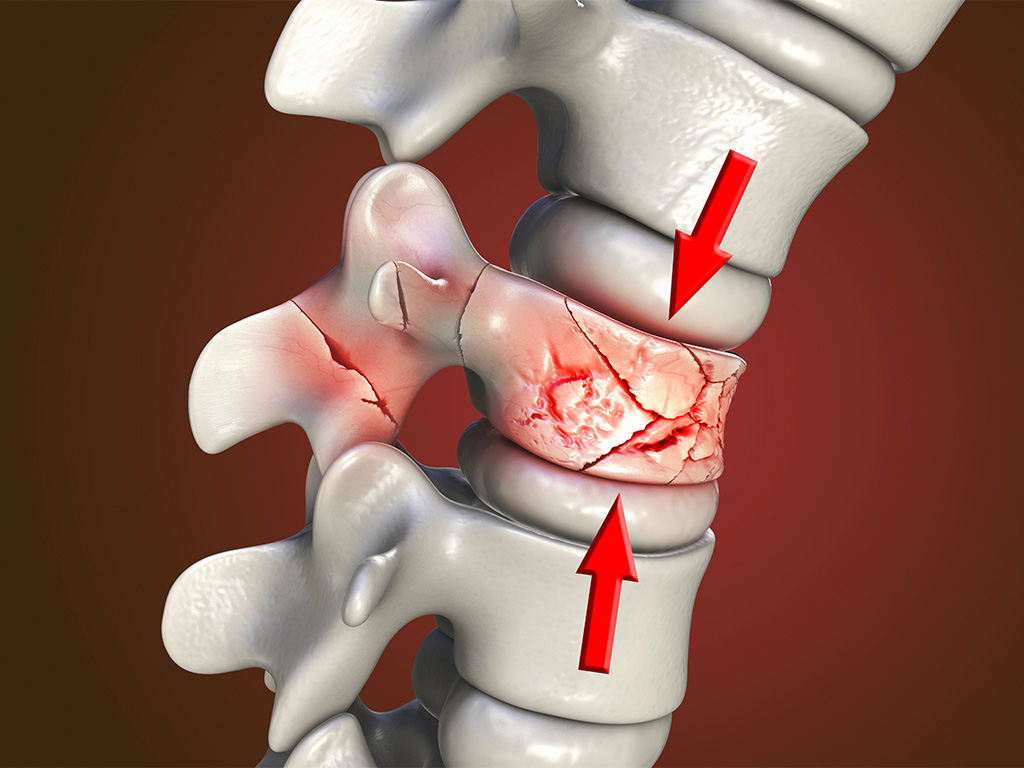 Compression Fractures: Vertebroplasty vs Kyphoplasty